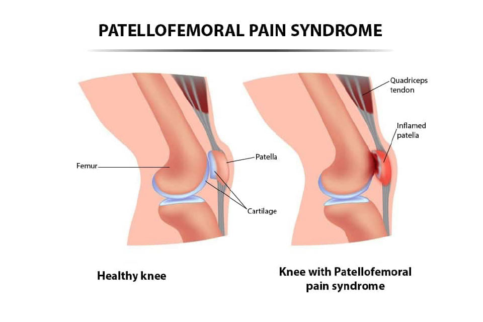 patellofemoral-pain-syndrome-ballarat-osm