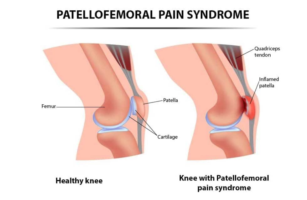 ballarat-osm-patellofermoral-pain-syndrom